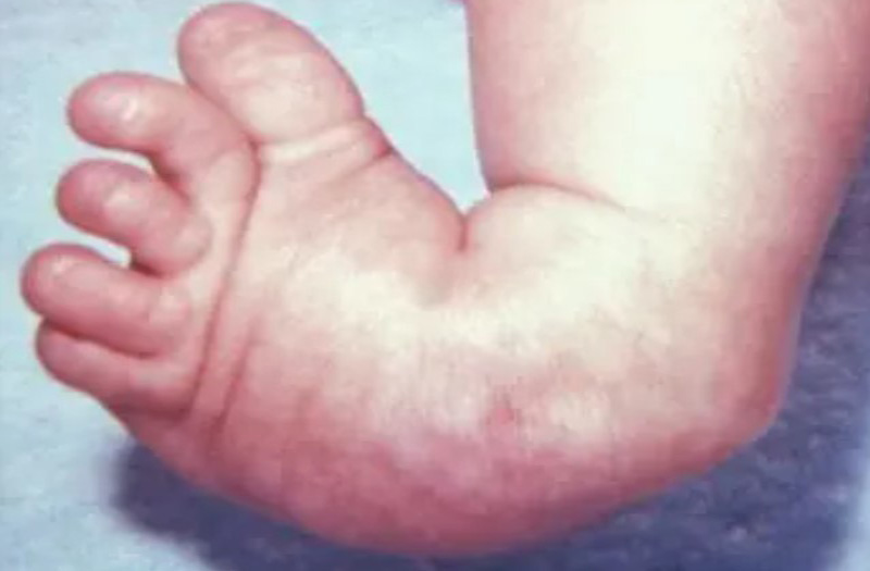 കുഞ്ഞുങ്ങളിലെ ക്ലബ് ഫൂട്ട് വൈകല്യത്തിന് സൗജന്യ ചികിത്സ